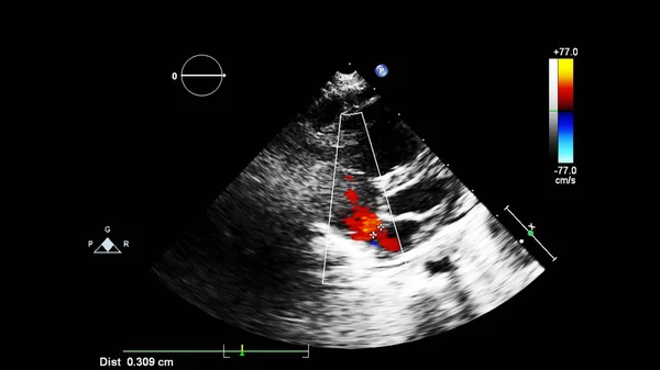 Immagine Del Cuore Durante Ecografia Transesofagea Con Modalità Doppler — Foto Stock