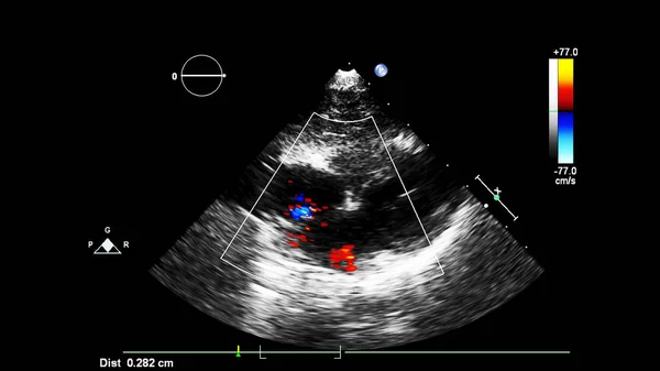 Beeld Van Het Hart Tijdens Transesofageale Echografie Met Doppler Modus — Stockfoto