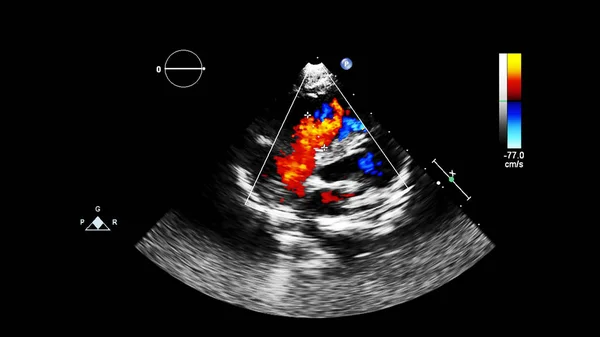 Imagem Coração Durante Ultrassom Transesofágico Com Modo Doppler — Fotografia de Stock