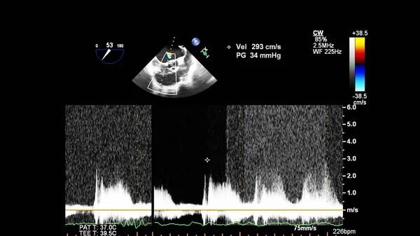 Transesofageal Ultrason Sırasında Doppler Kipi Ile Kalbin Görüntüsü — Stok fotoğraf