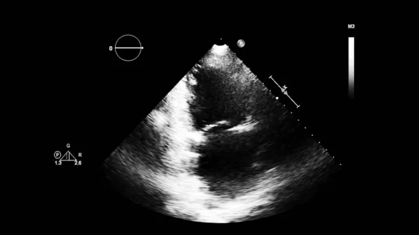 Transesofageal Ultrason Sırasında Kalbin Gri Ölçekli Görüntüsü — Stok fotoğraf