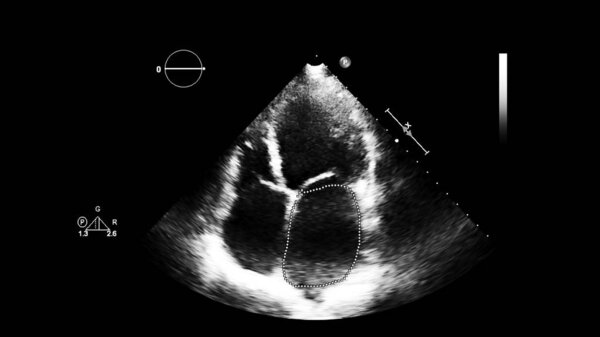Изображение сердца в сером режиме во время трансофагеального ультразвука.