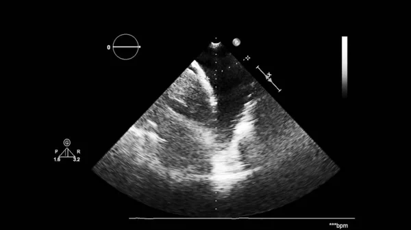 Transesofageal Ultrason Sırasında Kalbin Gri Ölçekli Görüntüsü — Stok fotoğraf