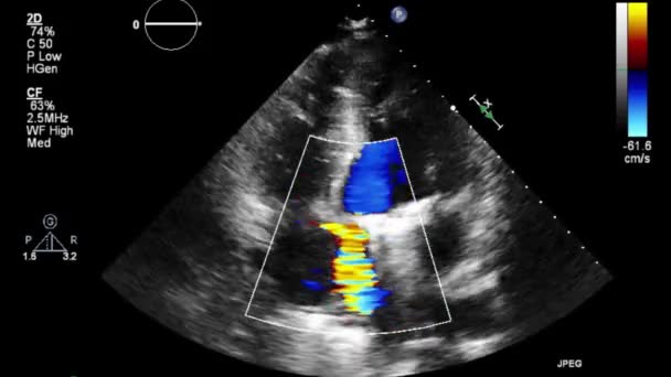 Hochwertige Video Ultraschall Transesophagealuntersuchung Des Herzens — Stockvideo