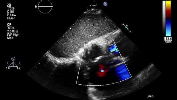 Ecografia Video Alta Qualità Esame Transesofageo Del Cuore — Video Stock