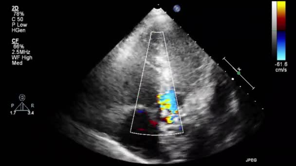 Качественное Видео Ультразвуковое Трансофагеальное Обследование Сердца — стоковое видео
