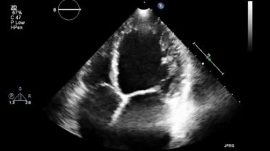 Kalbin yüksek kaliteli ultrason transsofageal muayenesi..