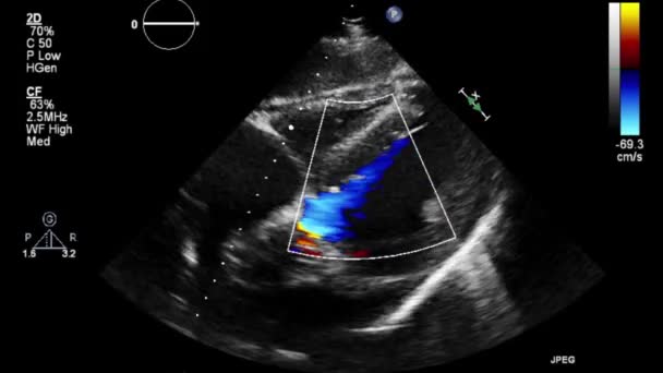 Vysoce Kvalitní Video Ultrazvukové Transesofageální Vyšetření Srdce — Stock video