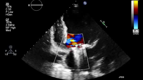 Ecografia Video Alta Qualità Esame Transesofageo Del Cuore — Video Stock