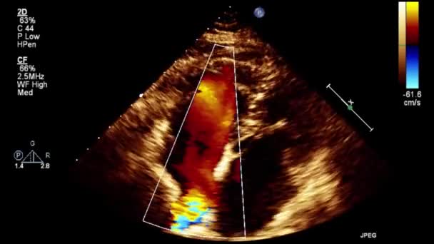 Качественное Видео Ультразвуковое Трансофагеальное Обследование Сердца — стоковое видео