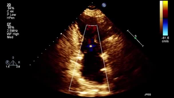 Examen Transesofágico Por Ultrasonido Video Alta Calidad Del Corazón — Vídeos de Stock