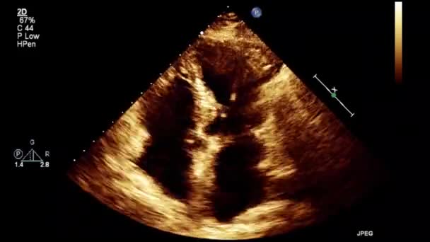 Hochwertige Video Ultraschall Transesophagealuntersuchung Des Herzens — Stockvideo