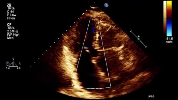 Échographie Vidéo Haute Qualité Examen Transœsophagien Cœur — Video