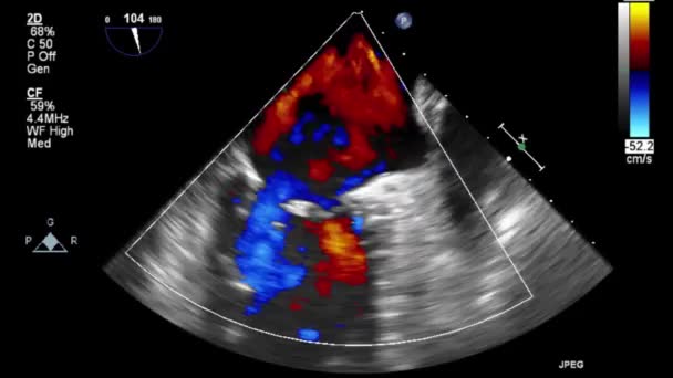 High Quality Video Ultrasound Transesophageal Examination Heart — Stock Video