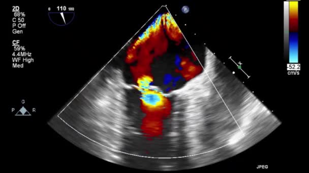 Examen Transesofágico Por Ultrasonido Video Alta Calidad Del Corazón — Vídeo de stock