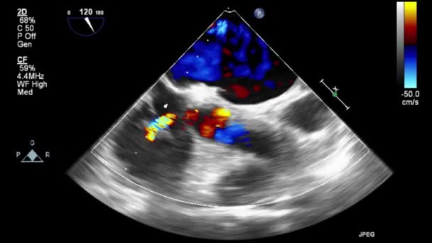 Examen Transesofágico Por Ultrasonido Video Alta Calidad Del Corazón — Vídeo de stock