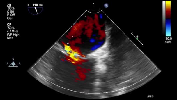 Hochwertige Video Ultraschall Transesophagealuntersuchung Des Herzens — Stockvideo