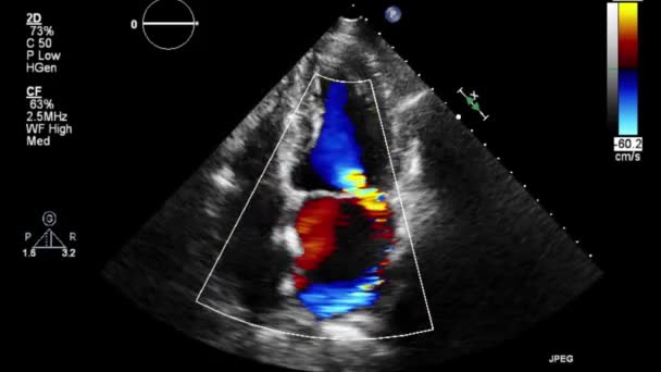 Kiváló Minőségű Videó Ultrahang Transznyelőcső Vizsgálata Szív — Stock videók