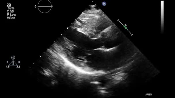 Ecografia Video Alta Qualità Esame Transesofageo Del Cuore — Video Stock