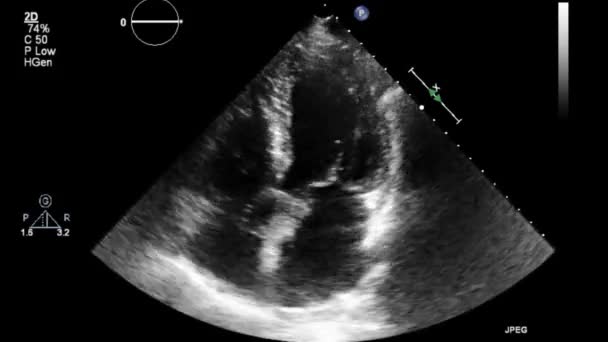 Hochwertige Video Ultraschall Transesophagealuntersuchung Des Herzens — Stockvideo