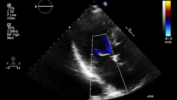 Examen Transesofágico Por Ultrasonido Video Alta Calidad Del Corazón — Vídeos de Stock