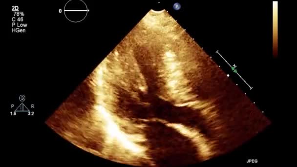 Examen Transesofágico Por Ultrasonido Video Alta Calidad Del Corazón — Vídeo de stock