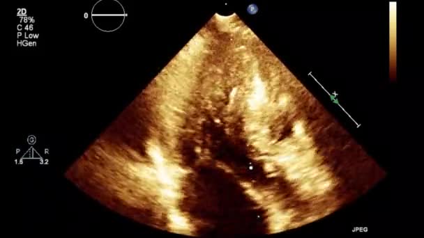 Examen Transesofágico Por Ultrasonido Video Alta Calidad Del Corazón — Vídeo de stock