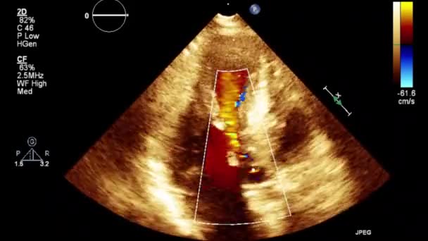 Качественное Видео Ультразвуковое Трансофагеальное Обследование Сердца — стоковое видео