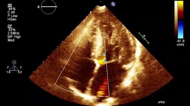 Échographie Vidéo Haute Qualité Examen Transœsophagien Cœur — Video