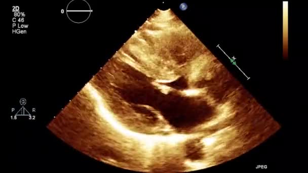 Examen Transesofágico Por Ultrasonido Video Alta Calidad Del Corazón — Vídeos de Stock