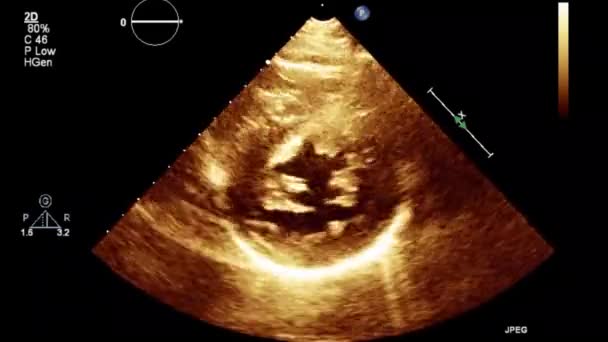 Hoge Kwaliteit Video Echografie Transslokdarmonderzoek Van Het Hart — Stockvideo