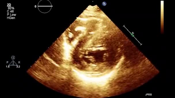 உயர இதயத Transophageal — ஸ்டாக் வீடியோ