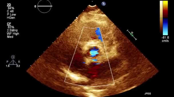 Examen Transesofágico Por Ultrasonido Video Alta Calidad Del Corazón — Vídeo de stock