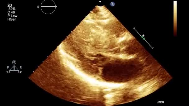 Качественное Видео Ультразвуковое Трансофагеальное Обследование Сердца — стоковое видео