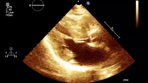 Examen Transesofágico Por Ultrasonido Video Alta Calidad Del Corazón — Vídeos de Stock