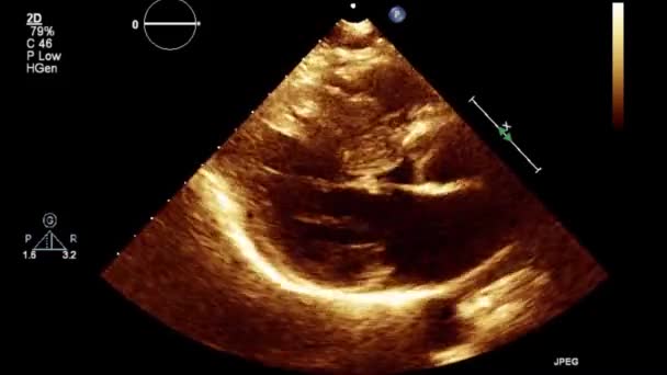 Examen Transesofágico Por Ultrasonido Video Alta Calidad Del Corazón — Vídeos de Stock