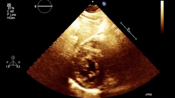 Hög Kvalitet Video Ultraljud Transesofageal Undersökning Hjärtat — Stockvideo
