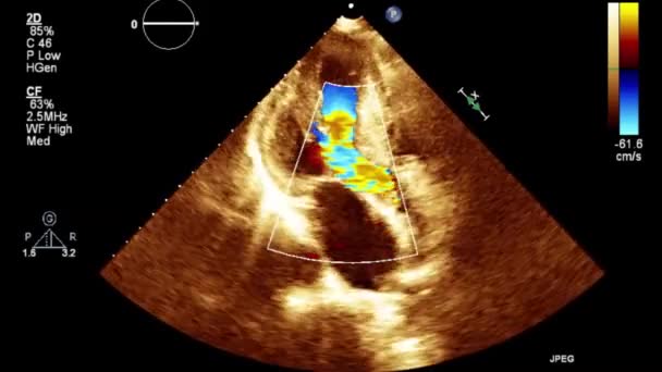 Якісне Відео Ультразвукове Трансофагеальне Дослідження Серця — стокове відео