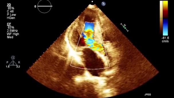 Examen Transesofágico Por Ultrasonido Video Alta Calidad Del Corazón — Vídeos de Stock