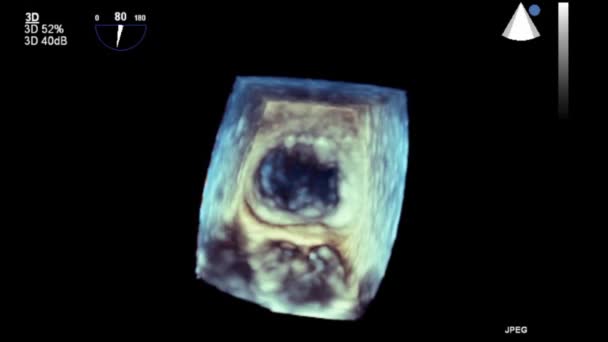 Hoge Kwaliteit Video Echografie Transslokdarmonderzoek Van Het Hart — Stockvideo