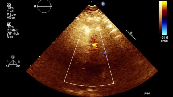 Examen Transesofágico Por Ultrasonido Video Alta Calidad Del Corazón — Vídeos de Stock