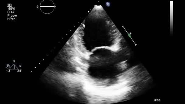 Examen Transesofágico Por Ultrasonido Video Alta Calidad Del Corazón — Vídeos de Stock