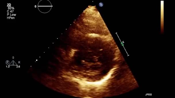 Examen Transesofágico Por Ultrasonido Video Alta Calidad Del Corazón — Vídeo de stock