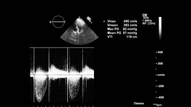 Transesofageal ultrason sırasında kalbin gri ölçekli görüntüsü.