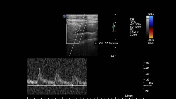 Examen Par Ultrasons Doppler Ondes Pulsées — Photo