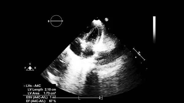 経食道超音波検査時のグレースケールモードで心臓の画像 — ストック写真