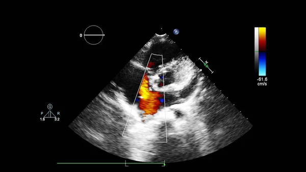 Immagine Del Cuore Durante Ecografia Transesofagea Con Modalità Doppler — Foto Stock