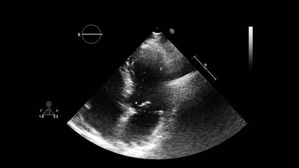 Abbildung Des Herzens Graustufen Modus Während Des Transesophagealen Ultraschalls — Stockfoto