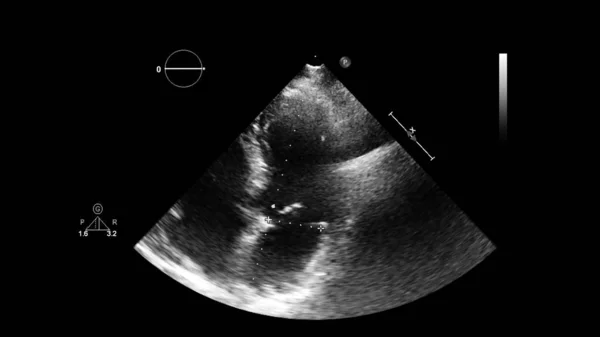 Imagem Coração Escala Cinza Durante Ultrassonografia Transesofágica — Fotografia de Stock