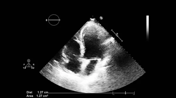 Transesofageal Ultrason Sırasında Kalbin Gri Ölçekli Görüntüsü — Stok fotoğraf